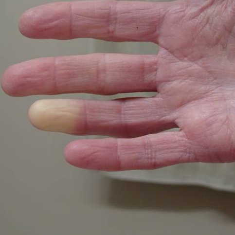 Fenômeno de Raynaud