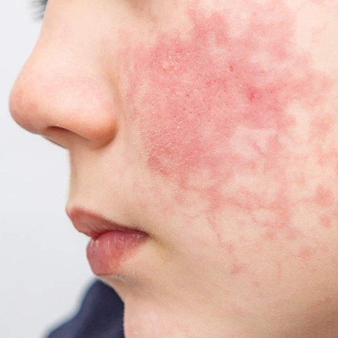Lupus Eritematoso Sistemico