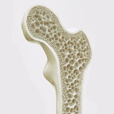 Osteoporose
